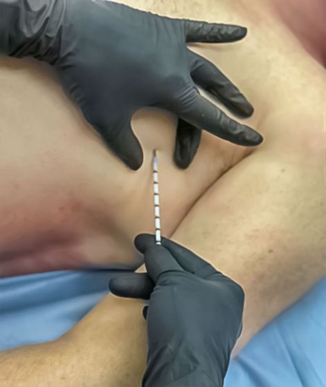 SPEAR - Simplified Pneumothorax Emergency Air Release