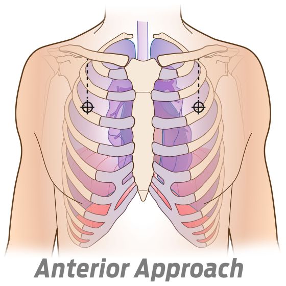SPEAR - Simplified Pneumothorax Emergency Air Release