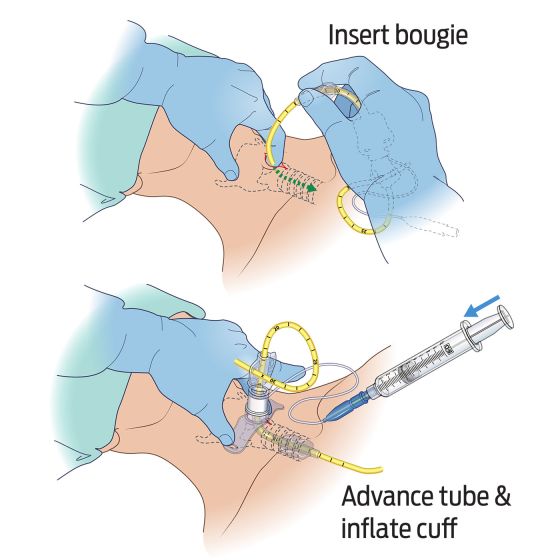 BAC-Pack - Bougie Aided Cricothyroidotomy Pack